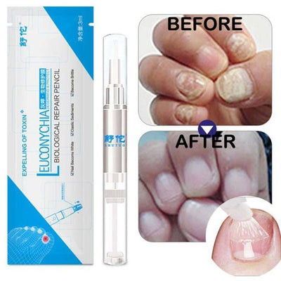 1Pcs Nail Fungal Treatment Pen Anti Fungus Infection Biological Repair Solution Nutritious Oil 3ml Restores Healthy Toenails - Zambeel