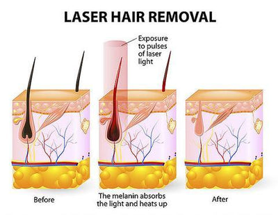 Laser Hair Removal Device - Zambeel