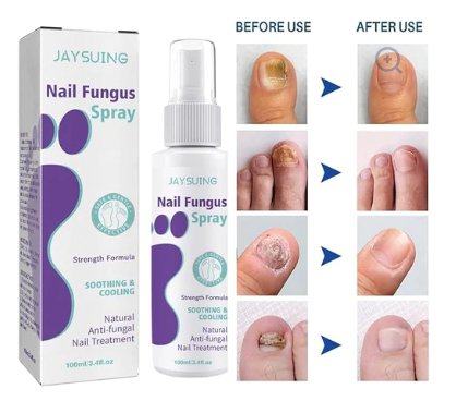 Nail Fungus Spray - Zambeel