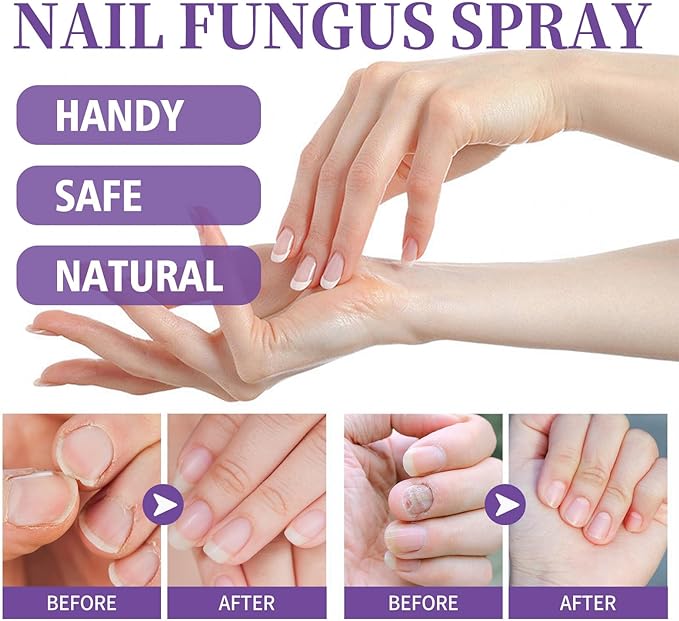 Nail Fungus Spray - Zambeel